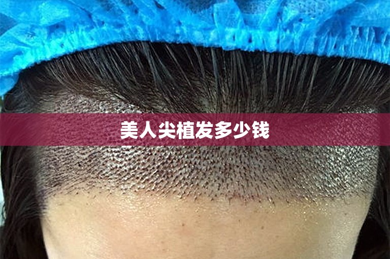 美人尖植发多少钱