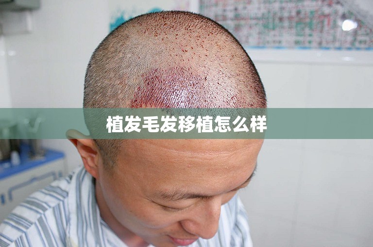 植发毛发移植怎么样