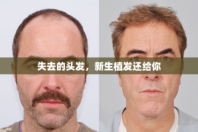 失去的头发，新生植发还给你