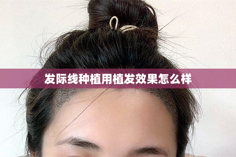 发际线种植用植发效果怎么样