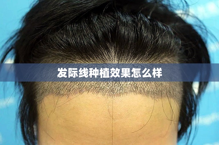发际线种植效果怎么样
