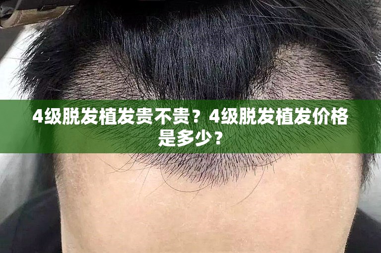 4级脱发植发贵不贵？4级脱发植发价格是多少？