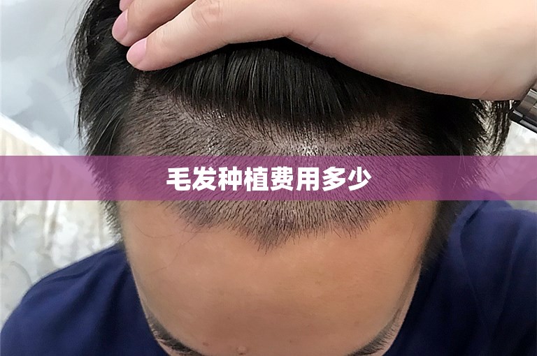 毛发种植费用多少