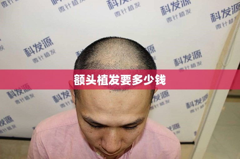 额头植发要多少钱
