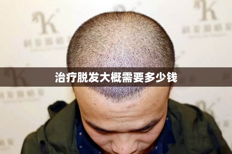 治疗脱发大概需要多少钱