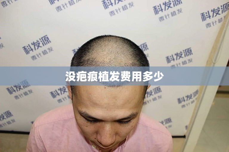 没疤痕植发费用多少