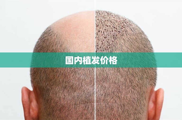 国内植发价格