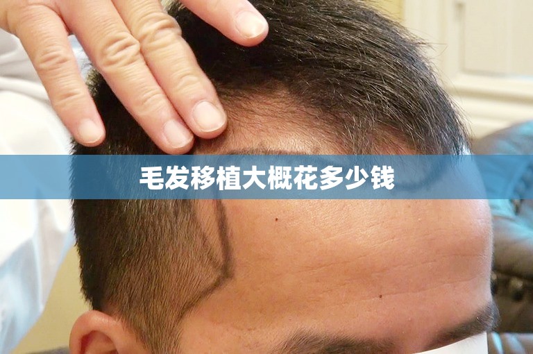 毛发移植大概花多少钱