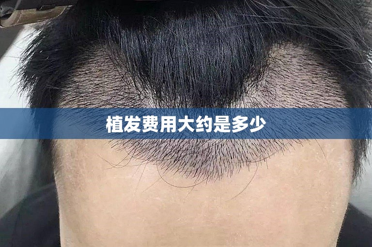 植发费用大约是多少