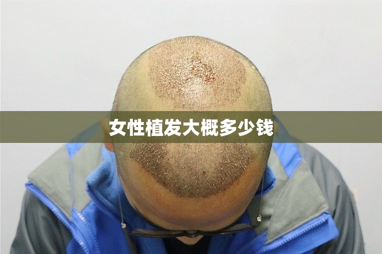 女性植发大概多少钱