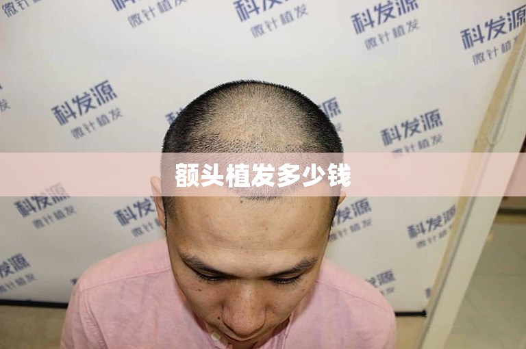 额头植发多少钱