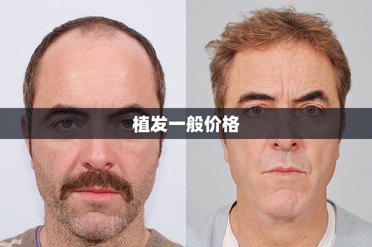植发一般价格