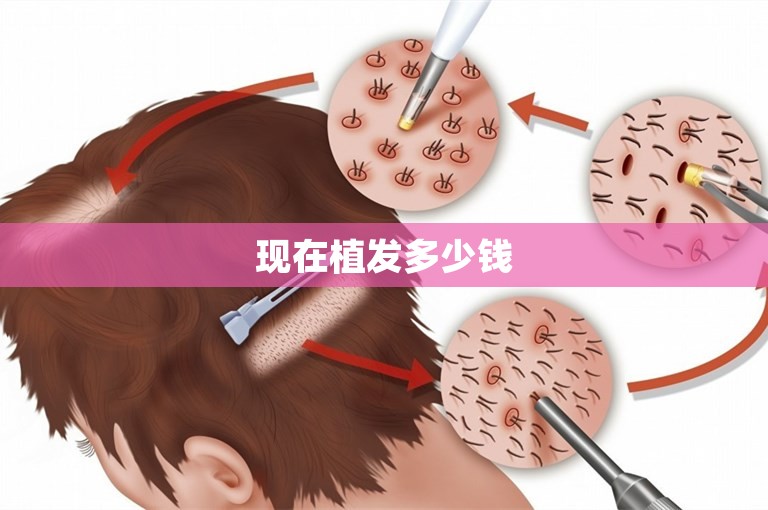 现在植发多少钱