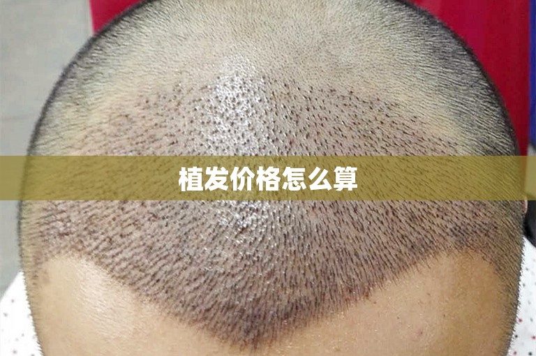 植发价格怎么算