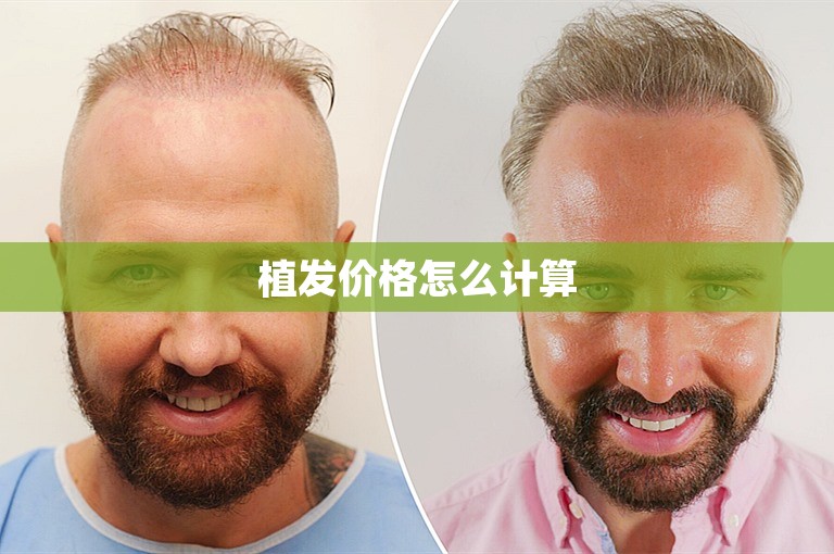 植发价格怎么计算