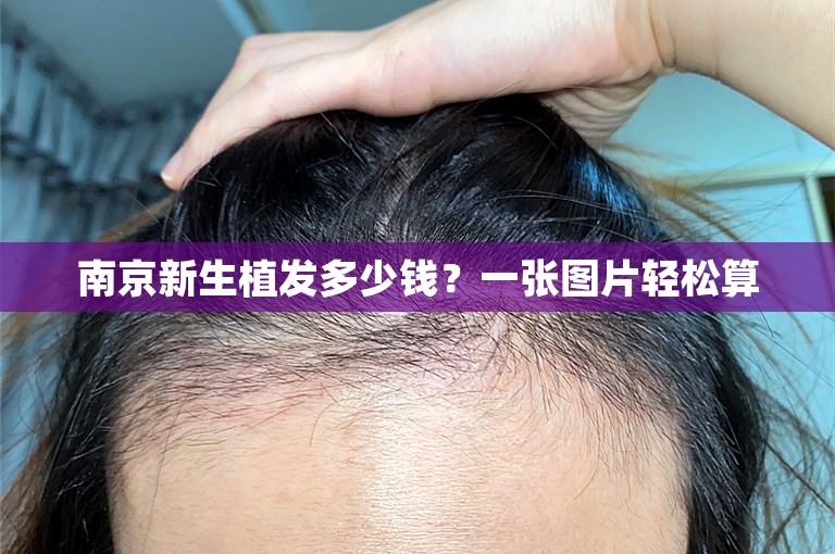 南京新生植发多少钱？一张图片轻松算