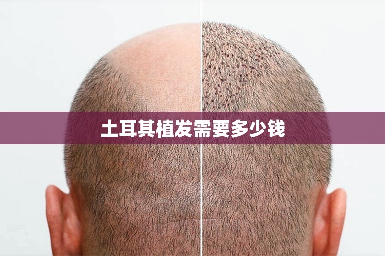 土耳其植发需要多少钱