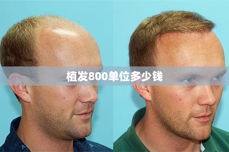 植发800单位多少钱