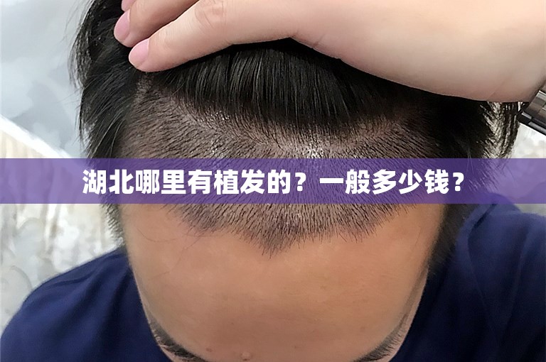 湖北哪里有植发的？一般多少钱？
