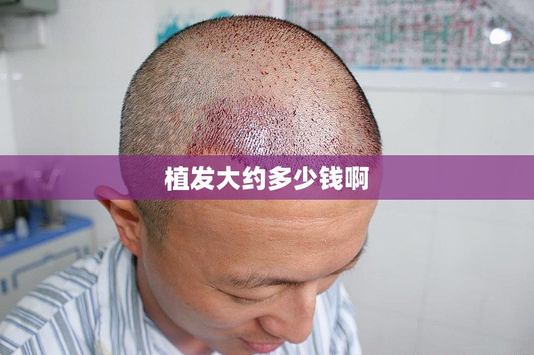 植发大约多少钱啊