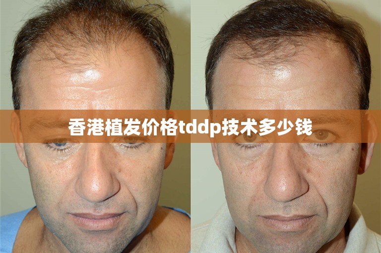 香港植发价格tddp技术多少钱