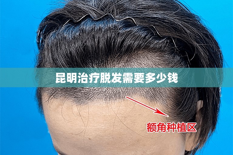 昆明治疗脱发需要多少钱