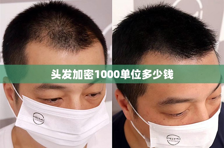 头发加密1000单位多少钱