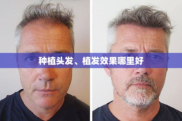 种植头发、植发效果哪里好
