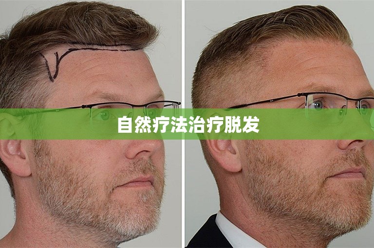 自然疗法治疗脱发