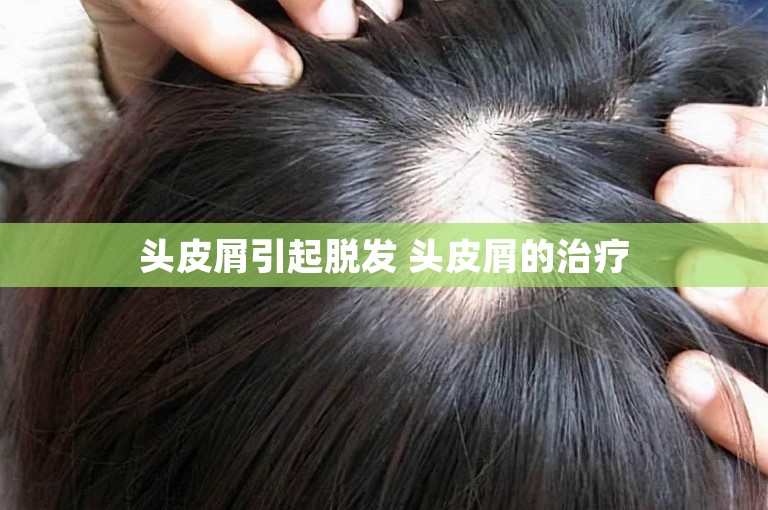 头皮屑引起脱发 头皮屑的治疗