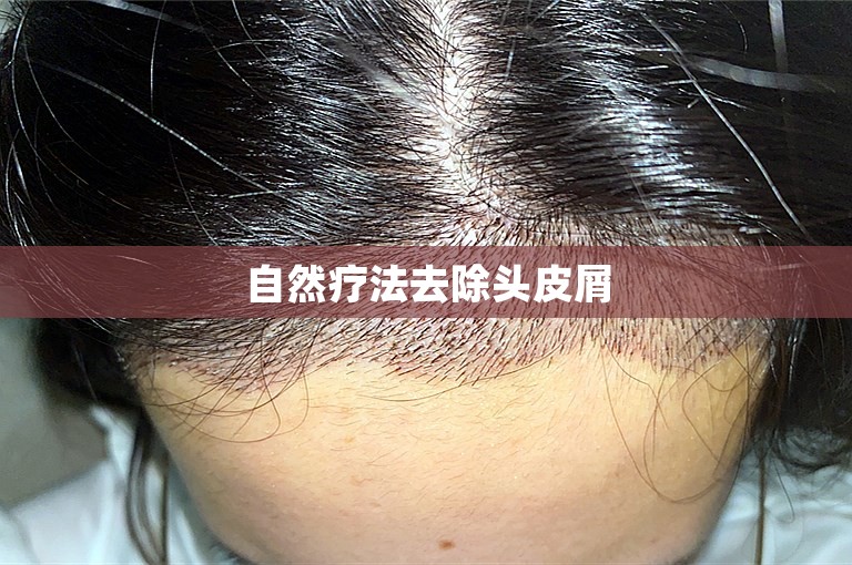 自然疗法去除头皮屑