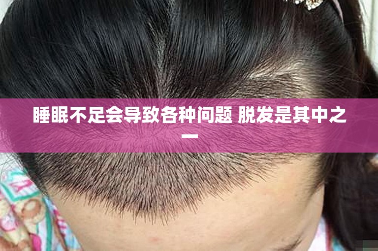 睡眠不足会导致各种问题 脱发是其中之一