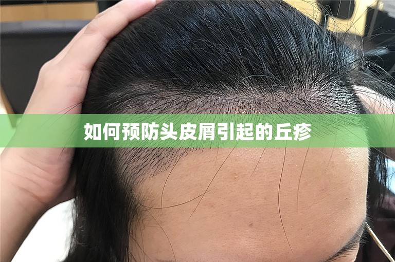 如何预防头皮屑引起的丘疹