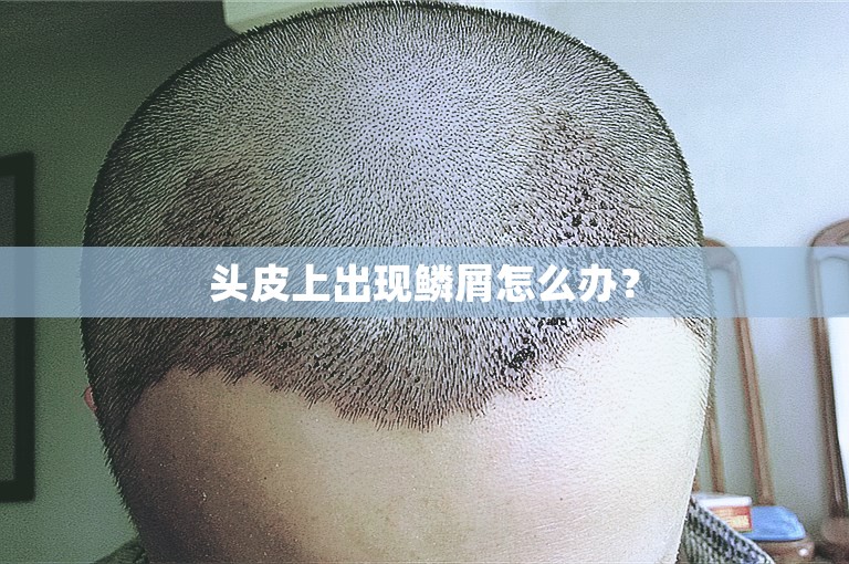 头皮上出现鳞屑怎么办？