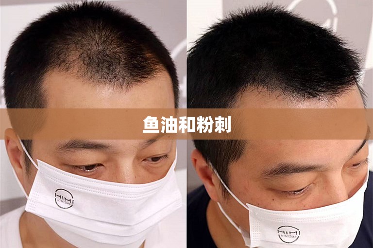 鱼油和粉刺