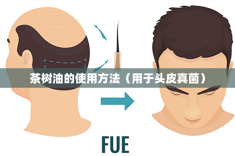 茶树油的使用方法（用于头皮真菌）