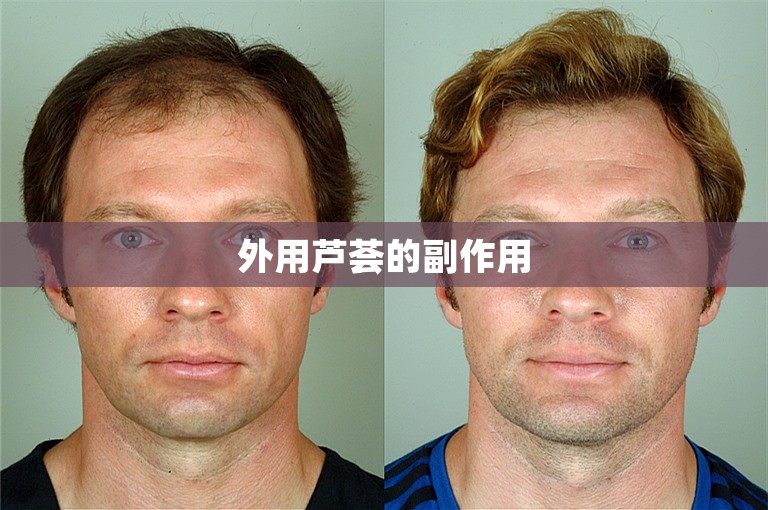 外用芦荟的副作用