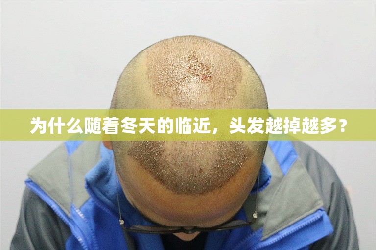 为什么随着冬天的临近，头发越掉越多？