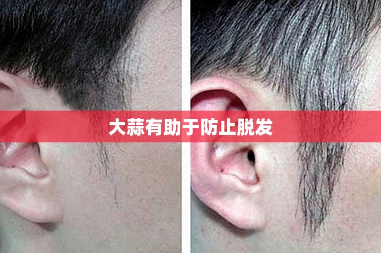 大蒜有助于防止脱发