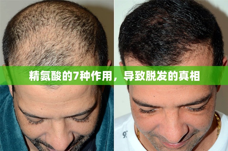 精氨酸的7种作用，导致脱发的真相