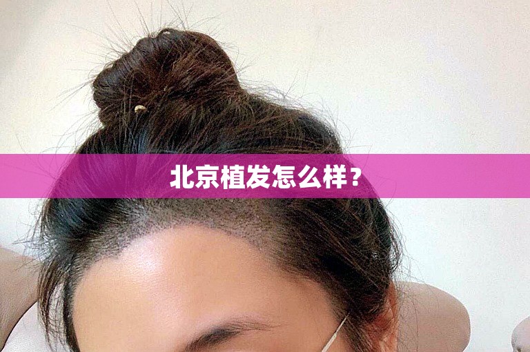 北京植发怎么样？