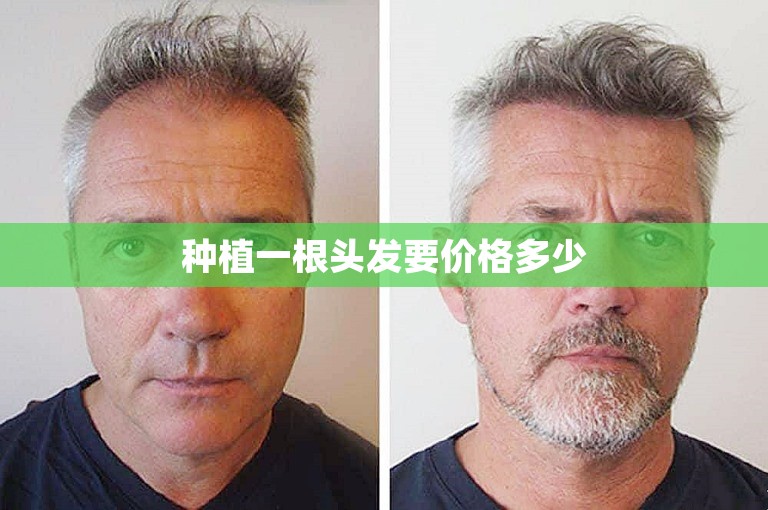 种植一根头发要价格多少