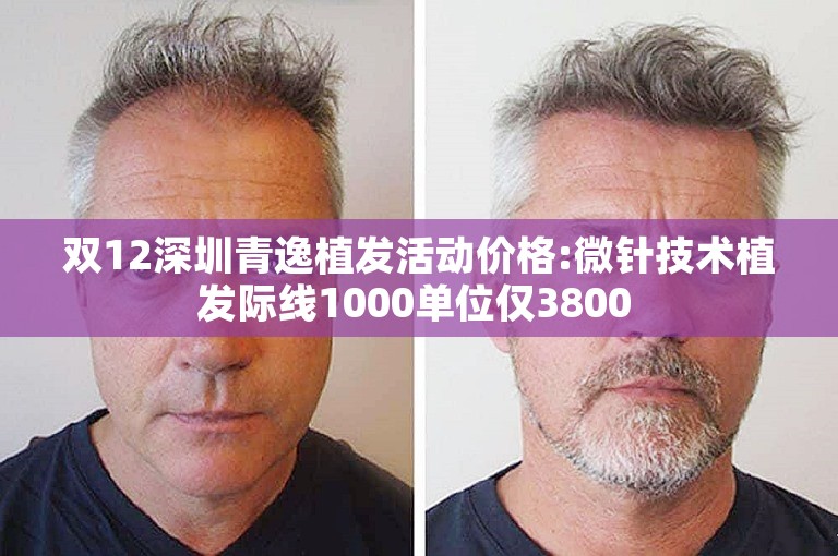 双12深圳青逸植发活动价格:微针技术植发际线1000单位仅3800 