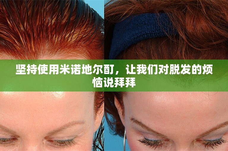 坚持使用米诺地尔酊，让我们对脱发的烦恼说拜拜