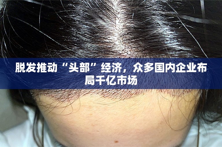 脱发推动“头部”经济，众多国内企业布局千亿市场