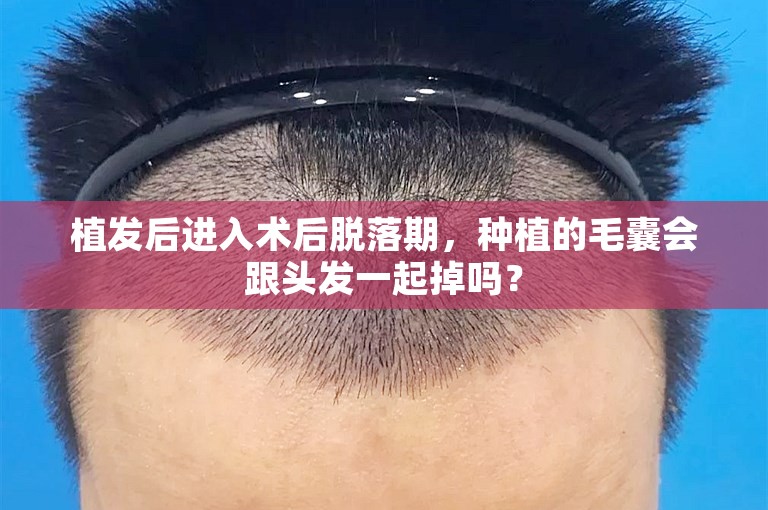 植发后进入术后脱落期，种植的毛囊会跟头发一起掉吗？