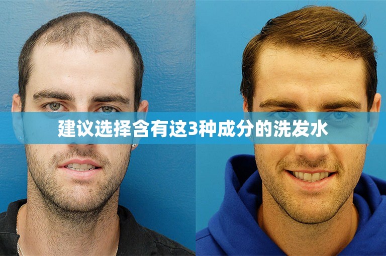 建议选择含有这3种成分的洗发水