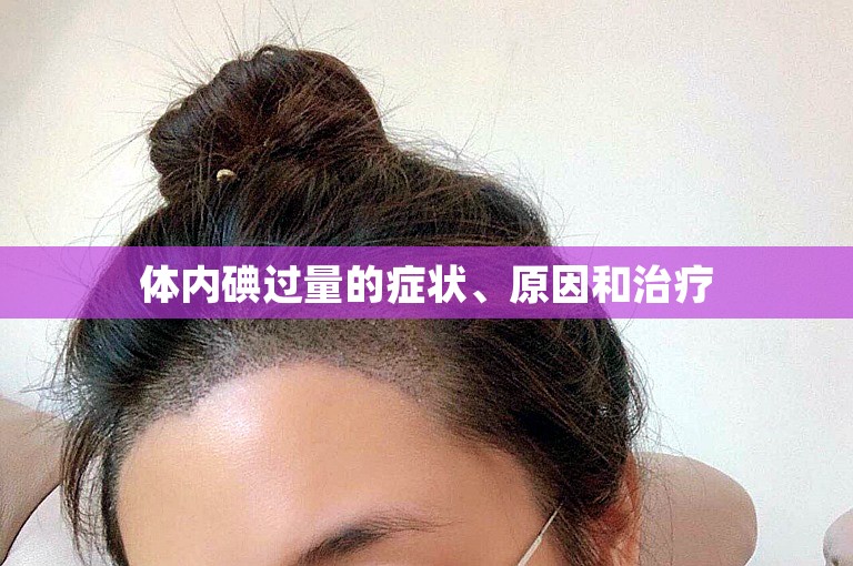体内碘过量的症状、原因和治疗