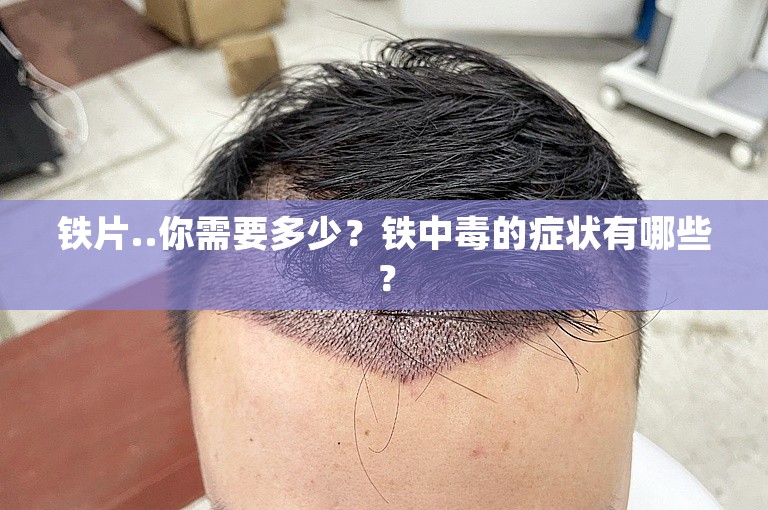 铁片..你需要多少？铁中毒的症状有哪些？