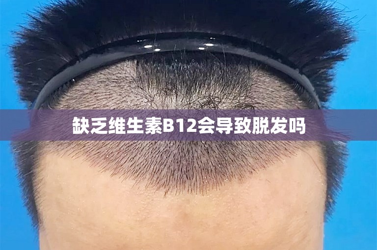 缺乏维生素B12会导致脱发吗